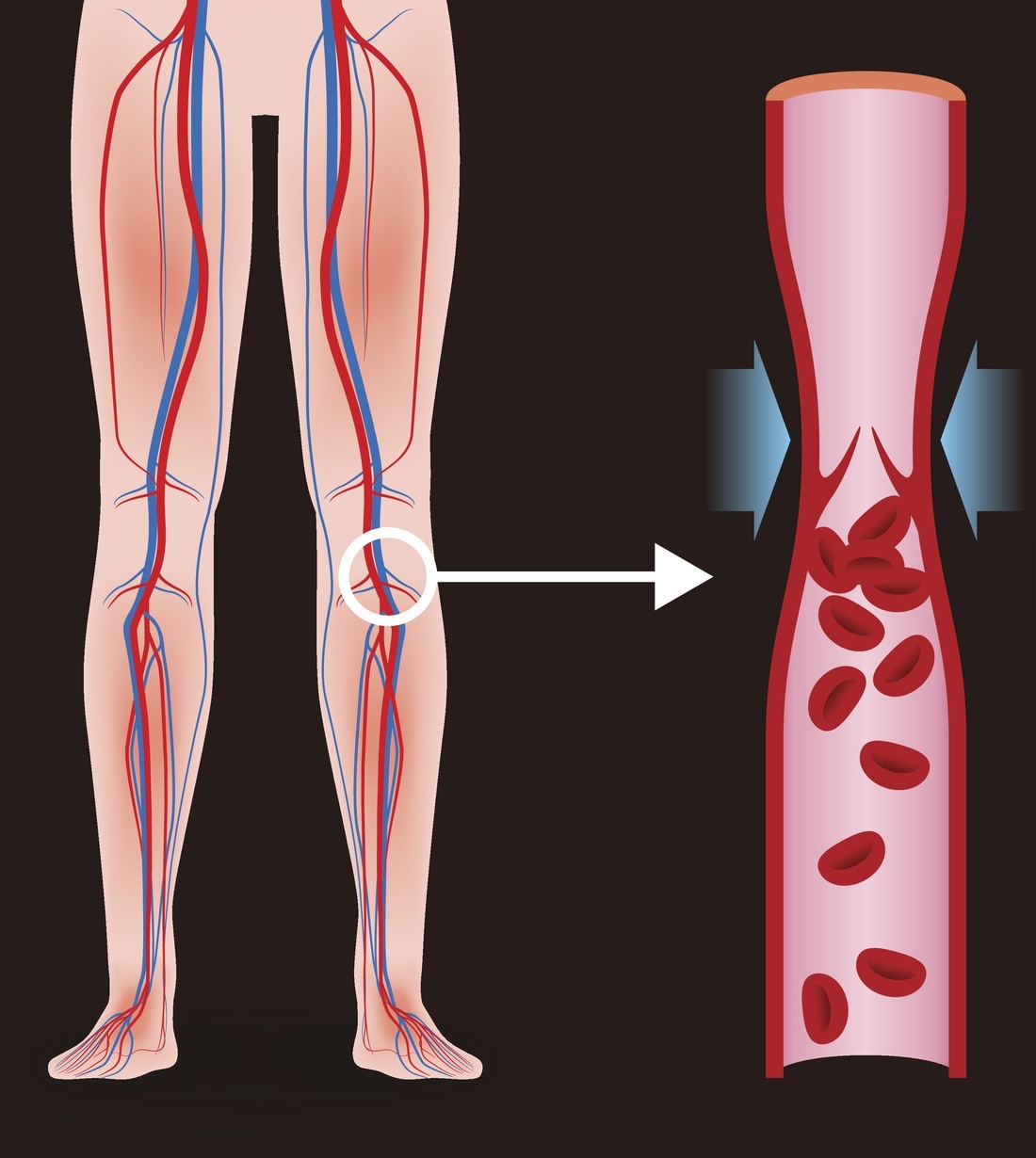 Deep Vein Thrombosis Research Paper